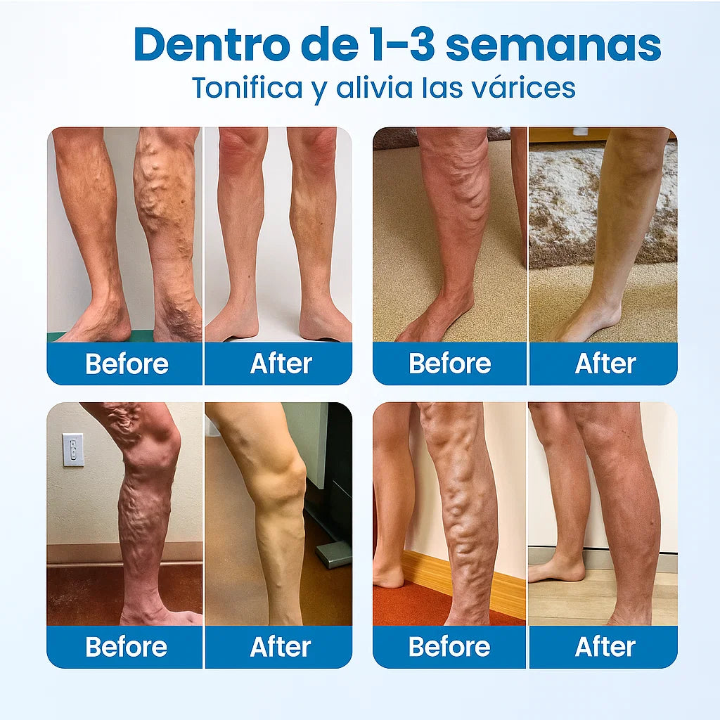 SPRAY VARICOSE VENAS