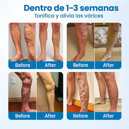 SPRAY VARICOSE VENAS