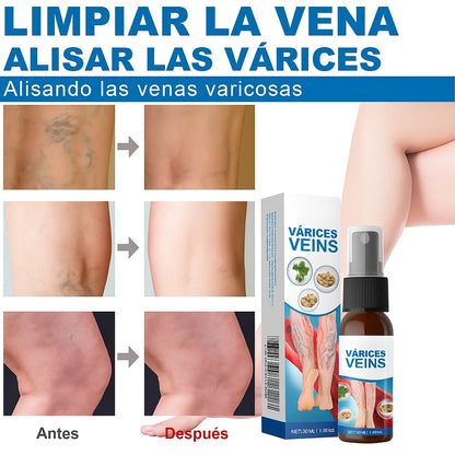 SPRAY VARICOSE VENAS